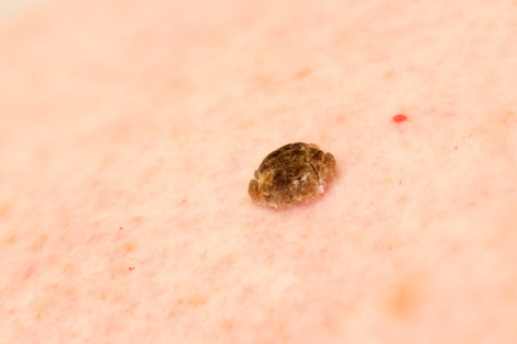 Book a senile wart or seborrhoeic keratosis removal at Crystal Palace Clinic