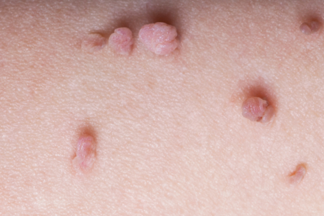 Book a skin tag removal appointment at Crystal Palace Clinic