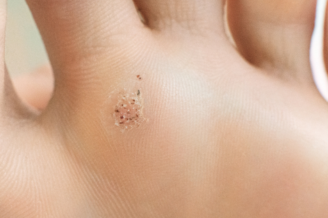 Verruca removal at Crystal Palace Clinic