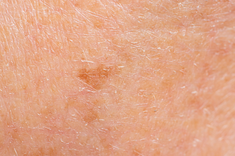 Age spot or solar lentigo removal