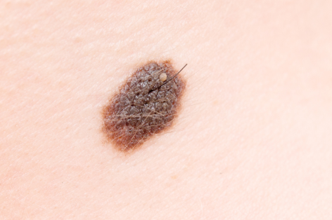 Book a removal of hairs from moles at Crystal Palace Clinic