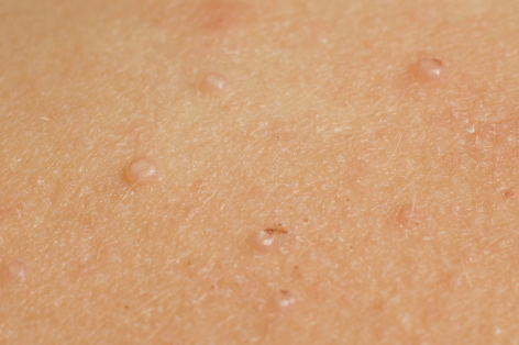 Book a plane wart removal at Crystal Palace Clinic