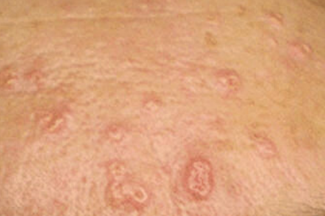 Sebaceous Hyperplasia removal at Crystal Palace Clinic