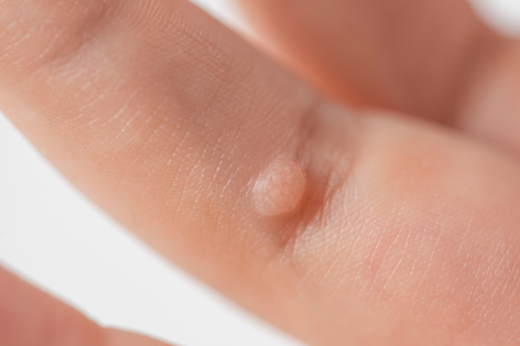 Wart removal at the Crystal Palace Clinic