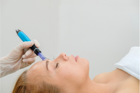 Microneedling at the Crystal Palace Clinic